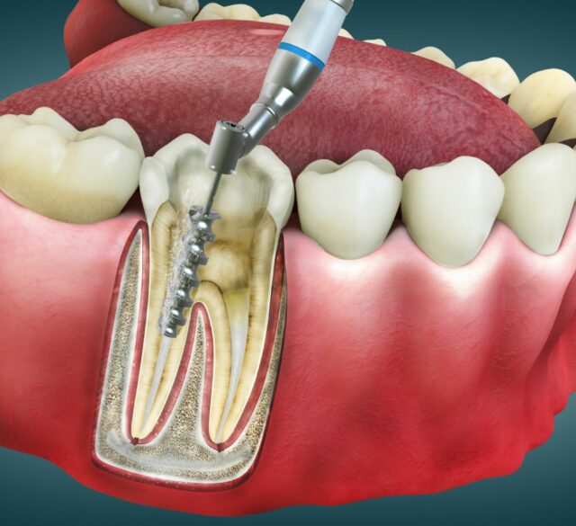 Root Canal Specialist in Mohali